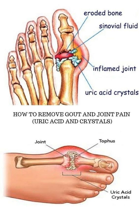 AVOID PURINE-RICH FOODS IF YOU HAVE GOUT - I VALUE MY LIFE